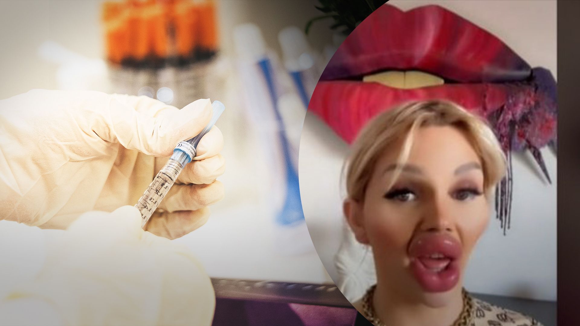 Женщина вколола в губы 30 миллилитров филеров – как она выглядит